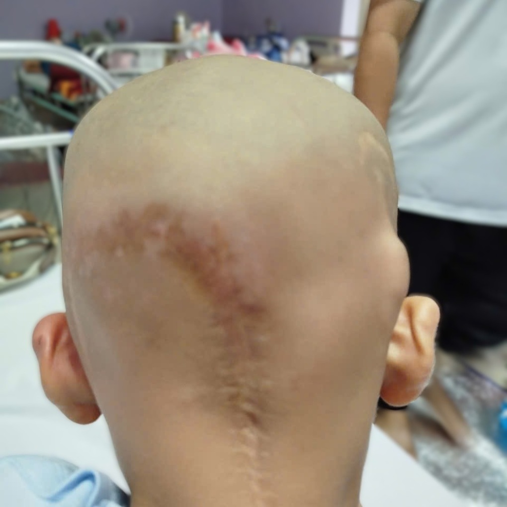 Bé trai vừa đi học đã phát hiện u não, mẹ đơn thân cầu cứu giúp đỡ - 3 Bé trai vừa đi học đã phát hiện u não, mẹ đơn thân cầu cứu giúp đỡ - 3
