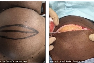 Video: Lấy u mỡ to như quả bóng bowling ở cổ