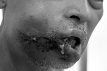 Khuôn mặt người đàn ông lở loét, biến dạng vì nặn mụn