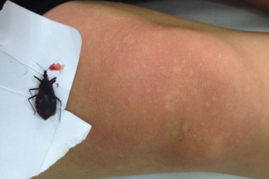 Nổi mề đay, tăng nhịp tim vì bọ xít đốt