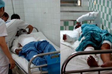 Đôi tình nhân bị tạt axít trong phòng trọ