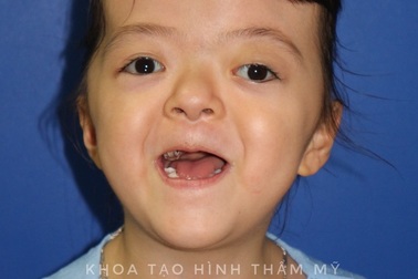 Cô bé mắc chứng hẹp hộp sọ được "nới" sọ thành công sau 6 lần phẫu thuật