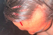 Nhiều bảo vệ tại dự án điện gió Sóc Trăng bị chém, ném bom xăng