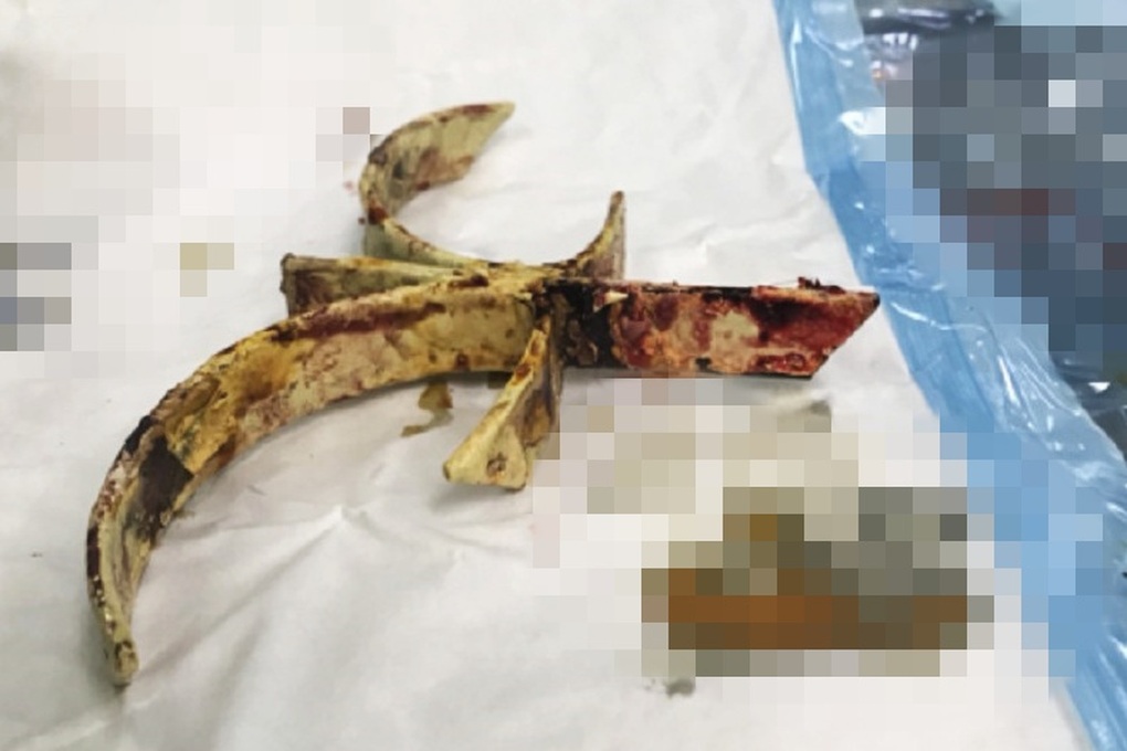 Người đàn ông bị đoạn sắt hàng rào cắm xuyên sọ 4cm - 2 Người đàn ông bị đoạn sắt hàng rào cắm xuyên sọ 4cm - 2
