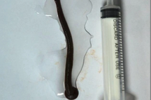 Đi bắt ốc, người đàn ông bị đỉa chui vào niệu đạo