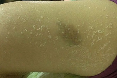 Tắm trắng tại nhà, cô gái bị "lột da" loang lổ toàn thân