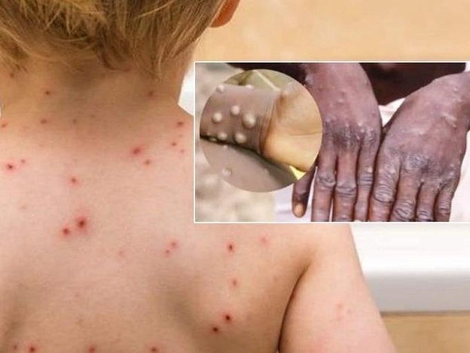 Bệnh đậu mùa khỉ và bệnh thủy đậu đều do virus gây ra nhưng vẫn có sự khác biệt.