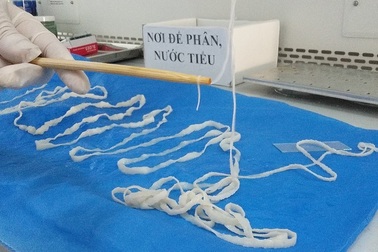“Ớn lạnh” trước con sán dây dài 5,2m trong cơ thể cô gái
