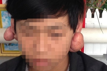 Kinh hoàng nổi u, phù tai sau khi bấm lỗ tai