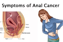 Những dấu hiệu cảnh báo ung thư hậu môn