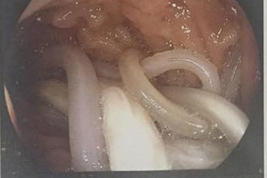 Kinh hoàng phát hiện từng búi giun chui lên tá tràng thai phụ