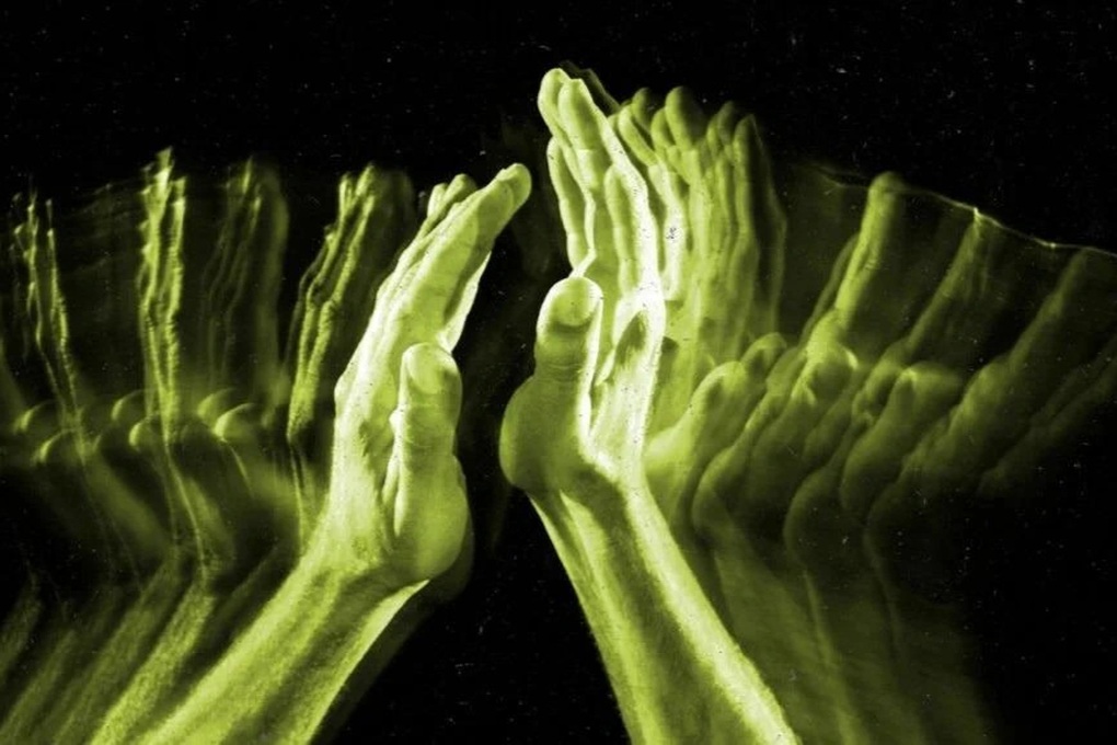 Síndrome de la mano alienígena: Rebeldes en el cuerpo - 1 Hội chứng bàn tay người ngoài hành tinh: Kẻ nổi loạn trong chính cơ thể - 1