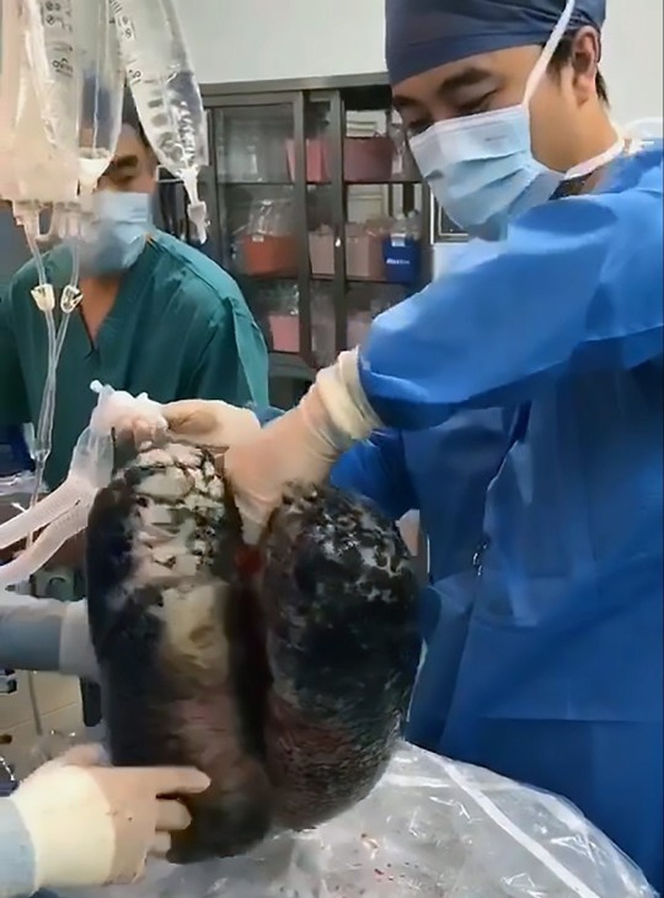 “Ám ảnh” lá phổi đen kịt của người 30 năm nghiện thuốc lá - 1 “Ám ảnh” lá phổi đen kịt của người 30 năm nghiện thuốc lá - 1