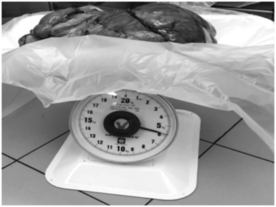 Đau tức bụng vào viện, người đàn ông phát hiện khối u nặng 6kg - 2 Đau tức bụng vào viện, người đàn ông phát hiện khối u nặng 6kg - 2