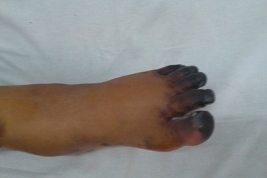 Phải tháo khớp 5 ngón chân vì hoại tử do cắt lể