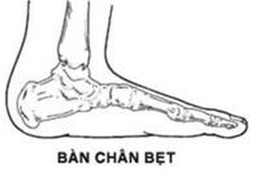 Nhận biết bàn chân bẹt ở trẻ