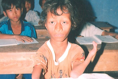 “Cậu bé da cam” và kỳ tích vượt qua lời nguyền luật tục 