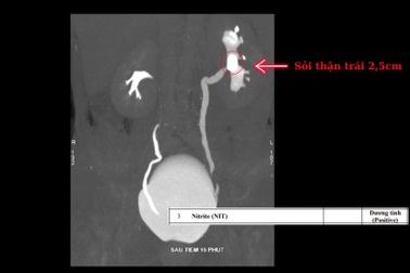 Chữa đau lưng 6 năm mới phát hiện nguyên nhân do sỏi thận