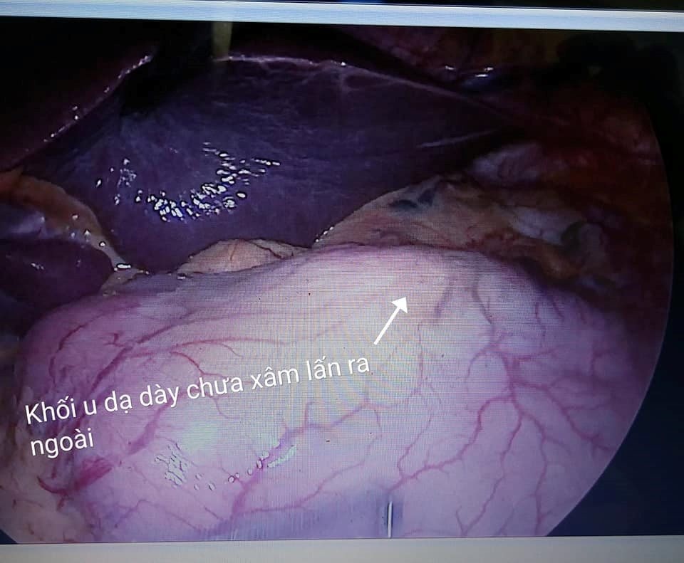 Phát hiện ca ung thư dạ dày sớm - 1 Phát hiện ca ung thư dạ dày sớm - 1