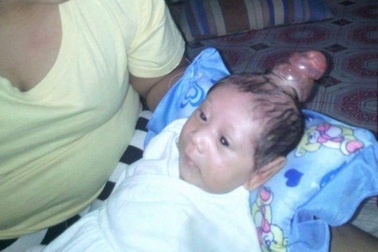 Em bé sinh ra với sừng mọc trên đầu gây sốc cho bác sĩ