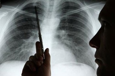 Điều trị ung thư phổi: Phương pháp nhắm trúng đích kết hợp xét nghiệm gen