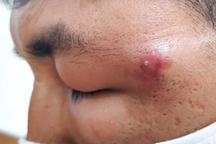 Chàng trai ở TPHCM phù mắt nặng, nguy cơ giảm thị lực chỉ vì một nốt mụn