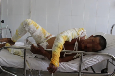 Liều mình dập đám cháy trong công ty, nam công nhân bị bỏng nặng