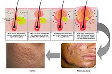 7 thắc mắc thường gặp về mụn trứng cá