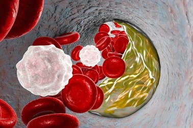 Bệnh mạch vành giai đoạn nào cũng nguy hiểm có thể tước đi mạng sống của bạn