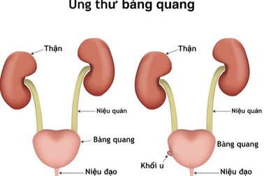 Ung thư bàng quang đe dọa những đối tượng này