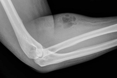 Tự tiêm tinh dịch của mình để “chữa trị”… đau lưng