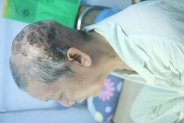 Điều trị lành tổn thương diện rộng hiếm gặp do ung thư da đầu