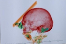 Phát hiện hài cốt người trong hành lý xách tay