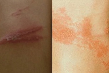 Khốn khổ vì dịch “giời leo” do côn trùng