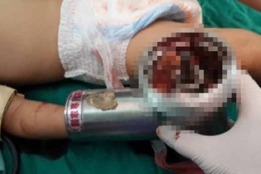 Bé 2 tuổi bị máy xay thịt nghiền nát tay