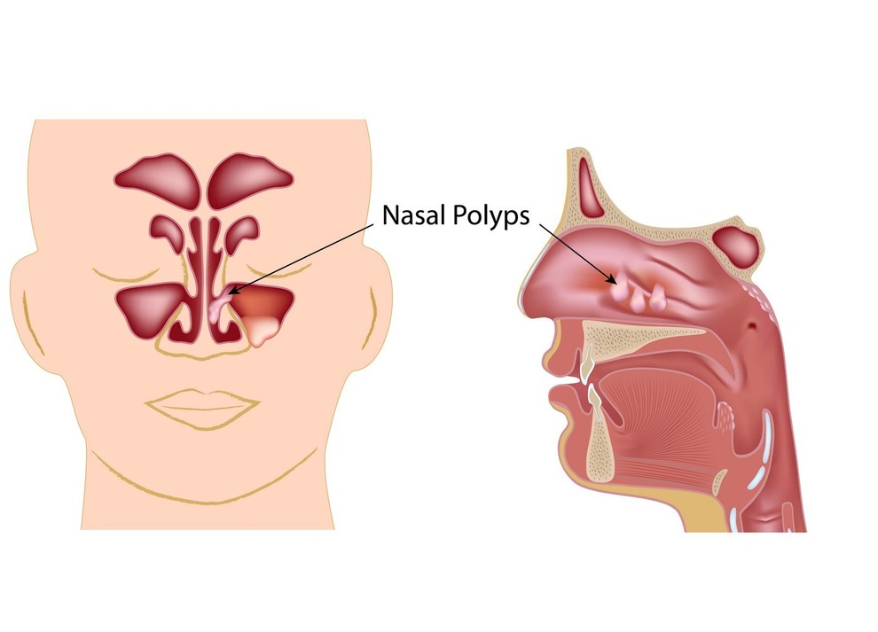 Polyp mũi: Triệu chứng và cách phòng ngừa - 1 Polyp mũi: Triệu chứng và cách phòng ngừa - 1