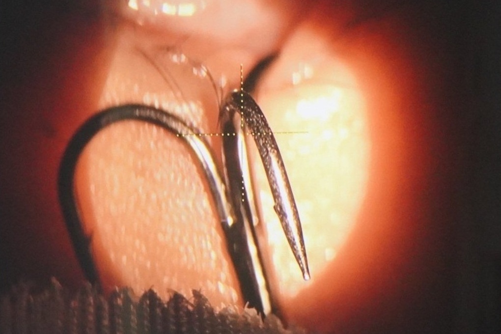 Cấp cứu bé trai 11 tuổi bị lưỡi câu sắc nhọn móc vào mắt khi đùa giỡn - 1 Cấp cứu bé trai 11 tuổi bị lưỡi câu sắc nhọn móc vào mắt khi đùa giỡn - 1