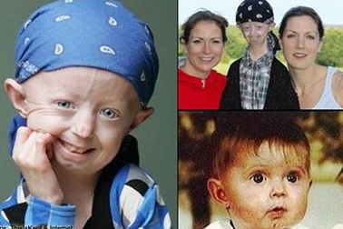 Căn bệnh quái ác biến bé gái thành cụ già 100 tuổi