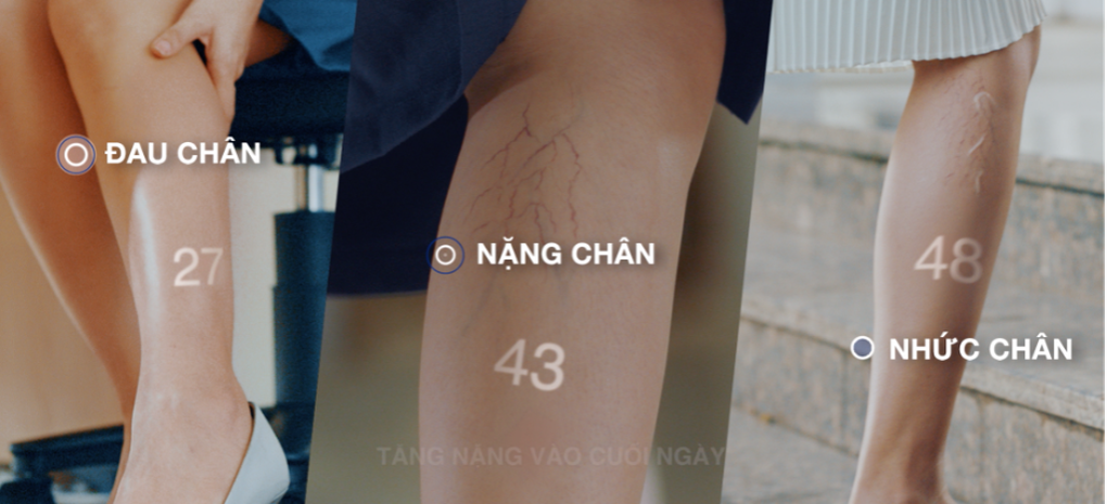 Giải pháp cải thiện triệu chứng suy giãn tĩnh mạch từ Pháp - 1 Giải pháp cải thiện triệu chứng suy giãn tĩnh mạch từ Pháp - 1