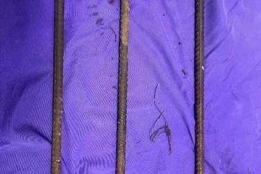 Cứu sống nam thanh niên ngã từ tầng cao, 3 cọc sắt xuyên ngang người