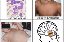 Ung thư trẻ em: Cha mẹ mới nhận ra bệnh!