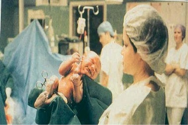 Không khuyến khích sản phụ thai to đẻ thường