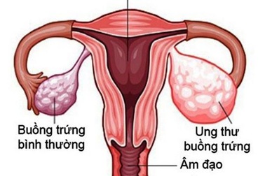 Liệu pháp tiêu chuẩn mới trong điều trị ung thư buồng trứng tái phát