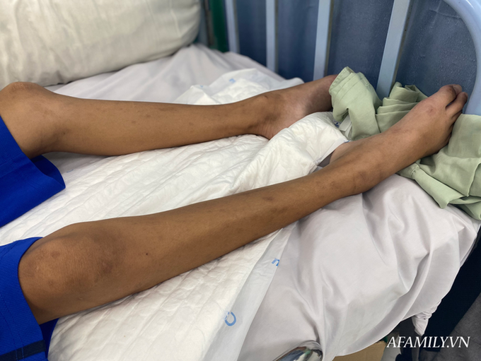 Thương tâm: Bé trai nằm liệt một chỗ sau tai nạn khóc nức nở trên giường bệnh, cha vay hàng trăm triệu đồng cứu con - Ảnh 3. Thương tâm: Bé trai nằm liệt một chỗ sau tai nạn khóc nức nở trên giường bệnh, cha vay hàng trăm triệu đồng cứu con - Ảnh 3.