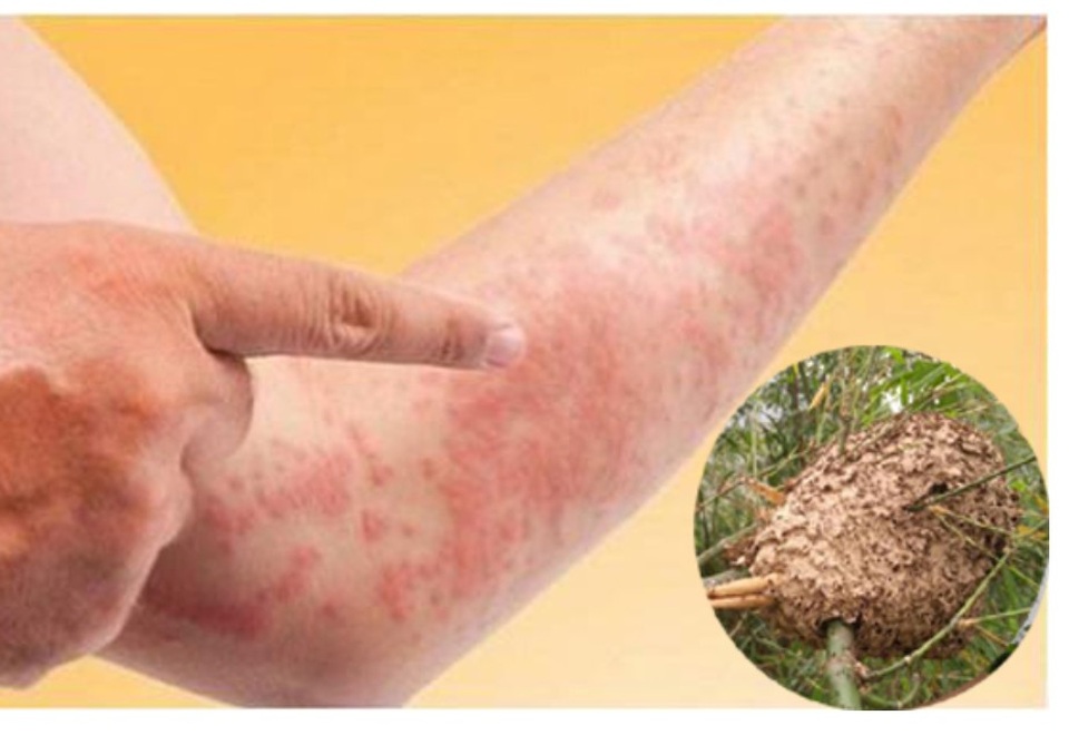 Ăn trứng kiến, thanh niên 21 tuổi nổi mẩn đỏ toàn thân, mắt sưng nề - 1 Ăn trứng kiến, thanh niên 21 tuổi nổi mẩn đỏ toàn thân, mắt sưng nề - 1