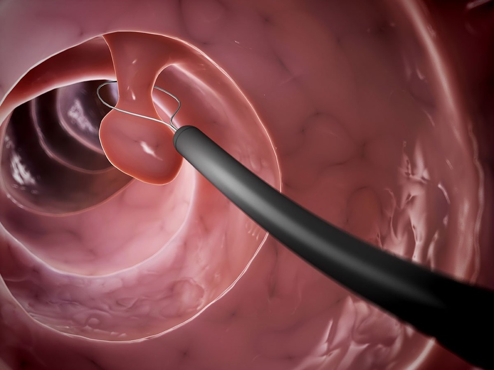 Khi nào cần sàng lọc polyp và ung thư đại trực tràng? - 1 Khi nào cần sàng lọc polyp và ung thư đại trực tràng? - 1