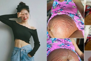 Hòa Minzy gây "sốc" khi dũng cảm công khai bụng rạn chằng chịt sau sinh
