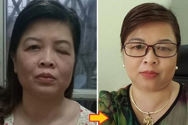 Bệnh sụp mí mắt - Nỗi lo của những người ở độ tuổi trung niên