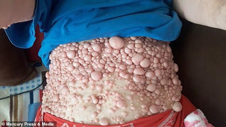 Người phụ nữ công khai cơ thể bị hàng ngàn khối u bao phủ - 2