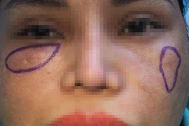 TPHCM: Cấp cứu 6 phụ nữ bị tai biến nặng nề vì tiêm filler